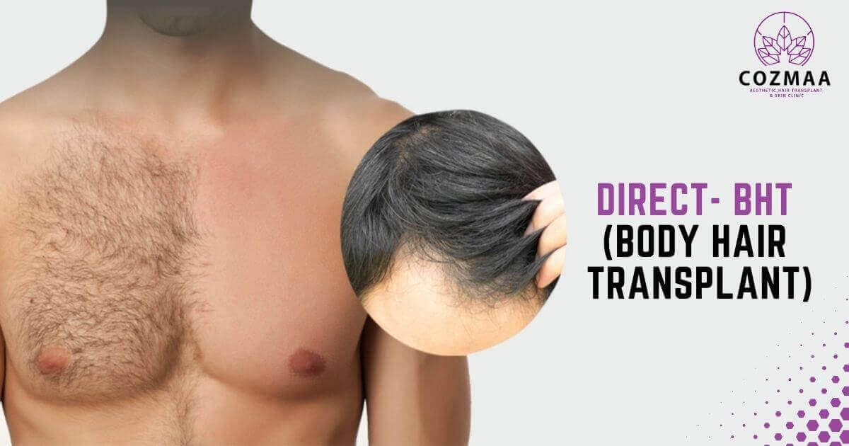 What is Direct-BHT (Body Hair Transplant)?
