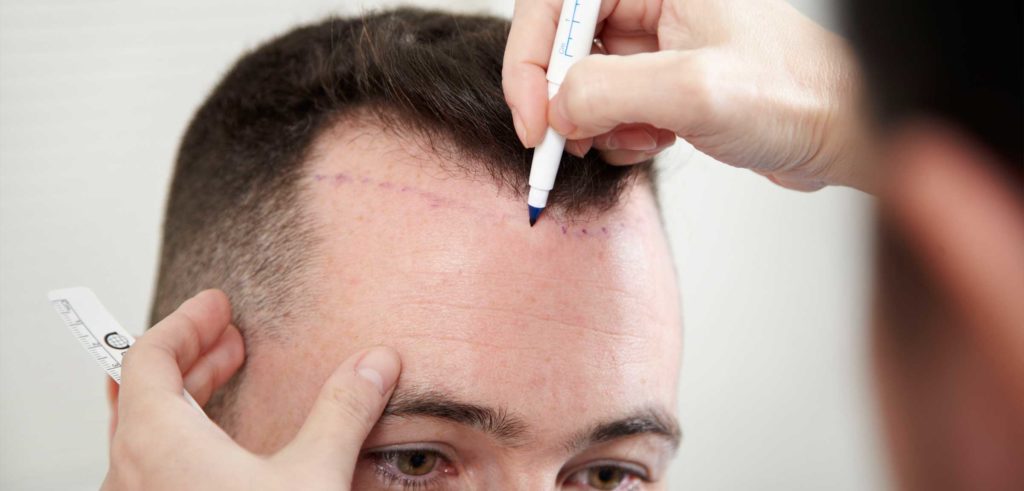 Hair Transplant - Cozmaa